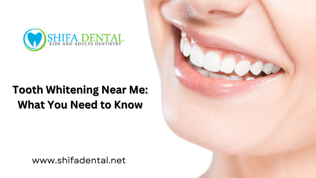 Tooth Whitening Near Me What You Need to Know